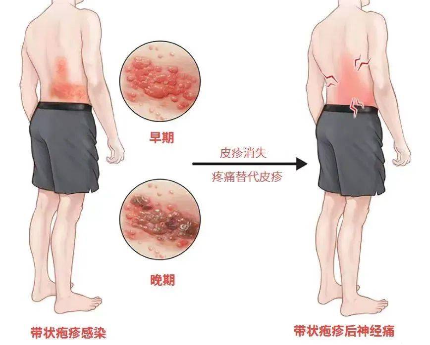 一旦感染終身攜帶！深圳疾控提醒：這4類人要注意