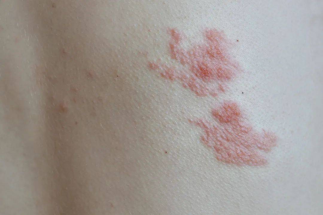 一旦感染終身攜帶！深圳疾控提醒：這4類人要注意