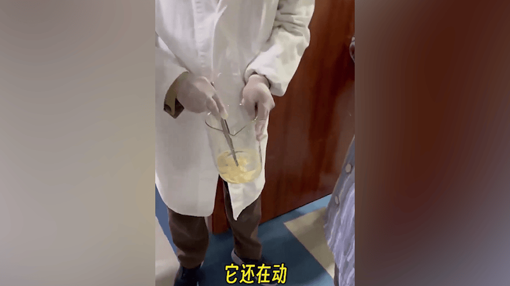 女子肛門處刺癢難忍，醫(yī)院用“南瓜籽+檳榔”驅(qū)蟲排出長達(dá)10米寄生蟲