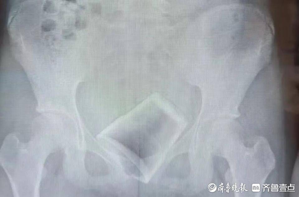 12歲男孩下體插著電線就診！醫(yī)生：這些尿道異物要注意
