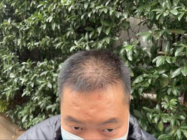 “還能反光！”長沙男子植發(fā)近9月稱后腦勺“像狗啃過”