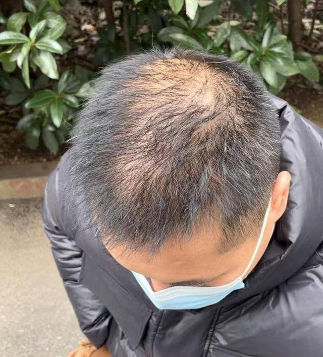 “還能反光！”長沙男子植發(fā)近9月稱后腦勺“像狗啃過”