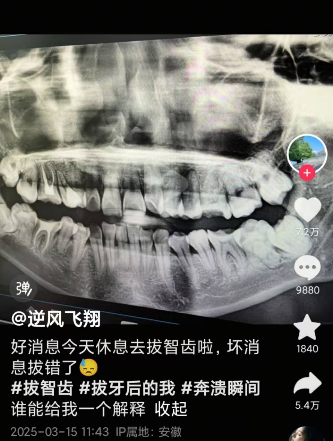 安徽一女子被拔錯牙后墜樓身亡，家屬：好牙位置沒打麻藥，硬生生拔下來