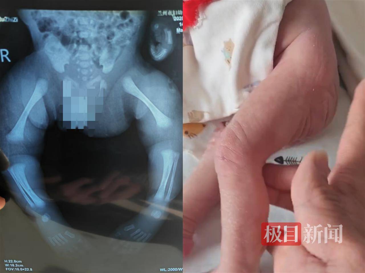 二胎出生查出先天性病癥或落下殘疾，殘疾父母稱醫(yī)院產(chǎn)檢漏檢、未盡告知義務(wù)，醫(yī)院及醫(yī)調(diào)委回應(yīng)