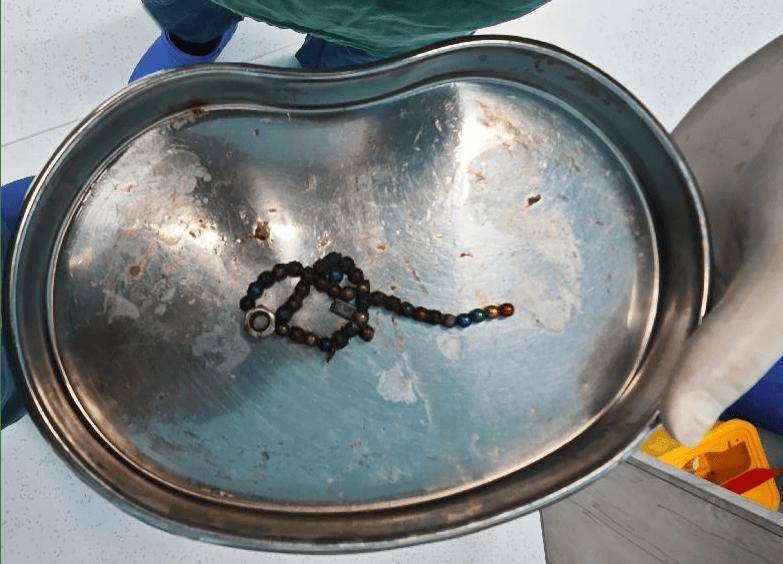 整整37顆！云南4歲孩子身體里取出……醫(yī)生緊急提醒！