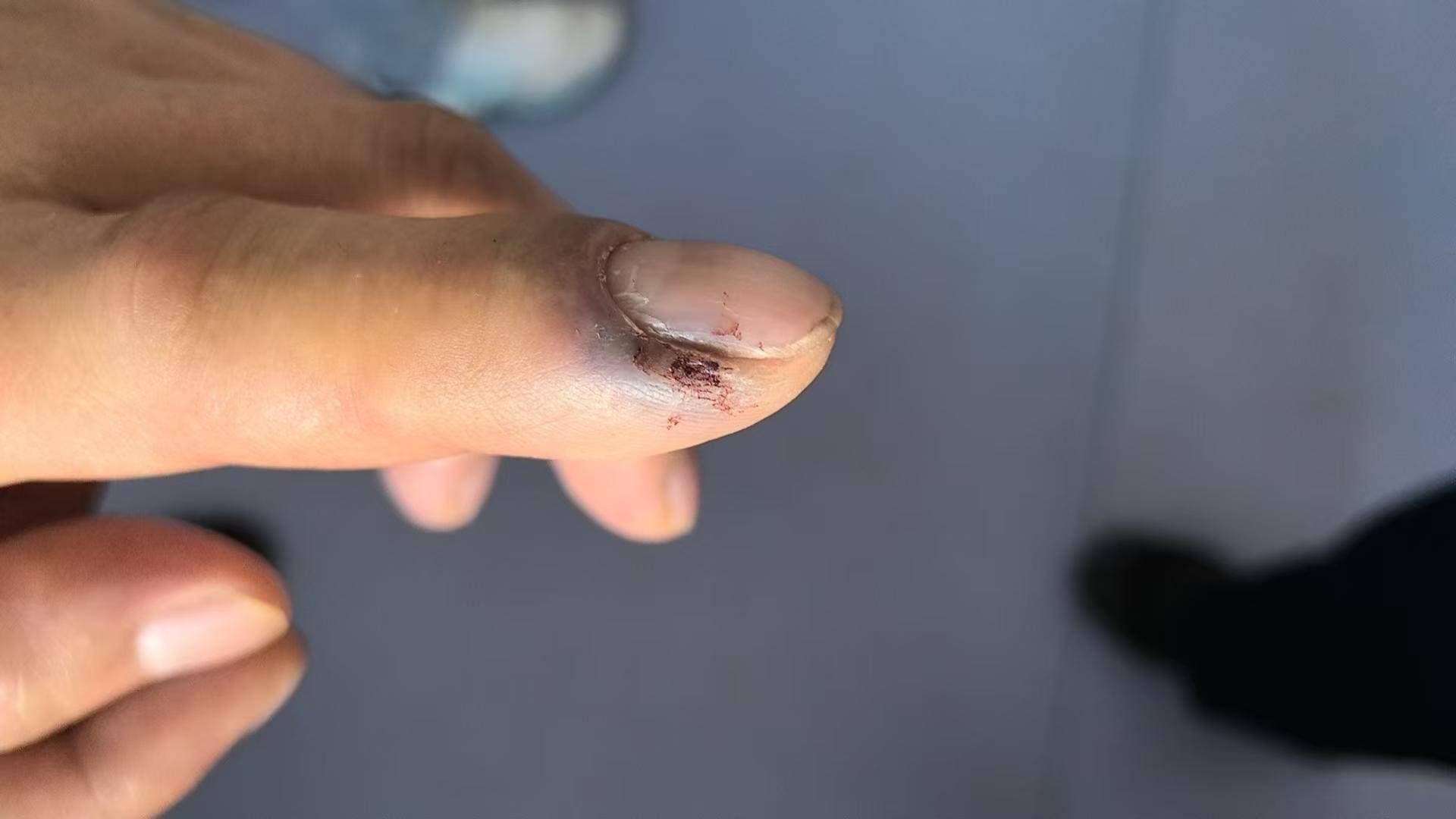 青海一男子被罕見(jiàn)劇毒阿拉善蝮蛇咬傷，因無(wú)血清一度想放棄治療 警車開(kāi)道轉(zhuǎn)運(yùn)700公里救命