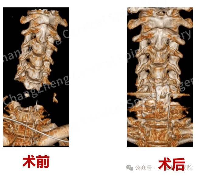 全球罕見！中國醫(yī)生救回“身首離斷”患者